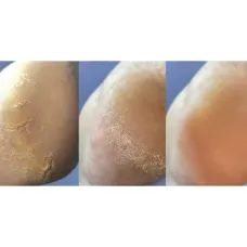 Крем від тріщин на шкірі рук та стоп, Nailsoftheday Podology+, 30 мл